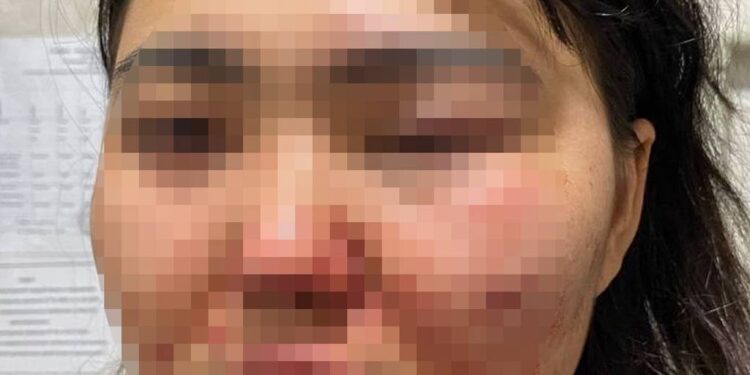 «Мені мүгедек қылды, бірақ әлі ешкім жазаланған жоқ»: Алматылық әйел полицияның әрекетсіздігіне шағымданды