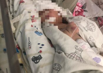 Жаңа туған нәресте перзентханада оңбай күйіп қалды